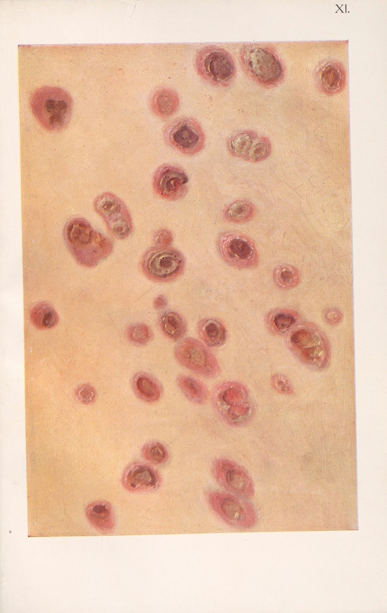 Venereal diseases  Syphilis Pl11 1908