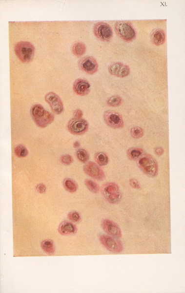 Venereal diseases  Syphilis Pl11 1908