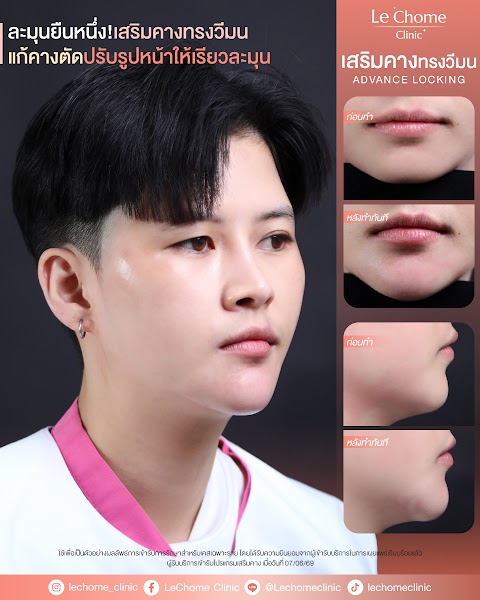 รีวิวเสริมคาง — เสริมคางผู้ชาย