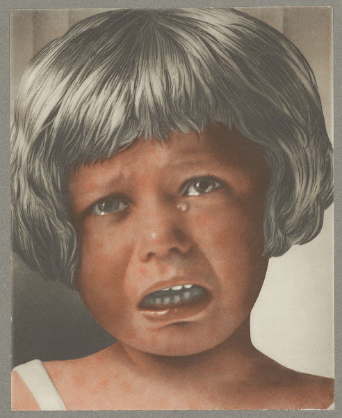 Rougeole Erythra 1936
