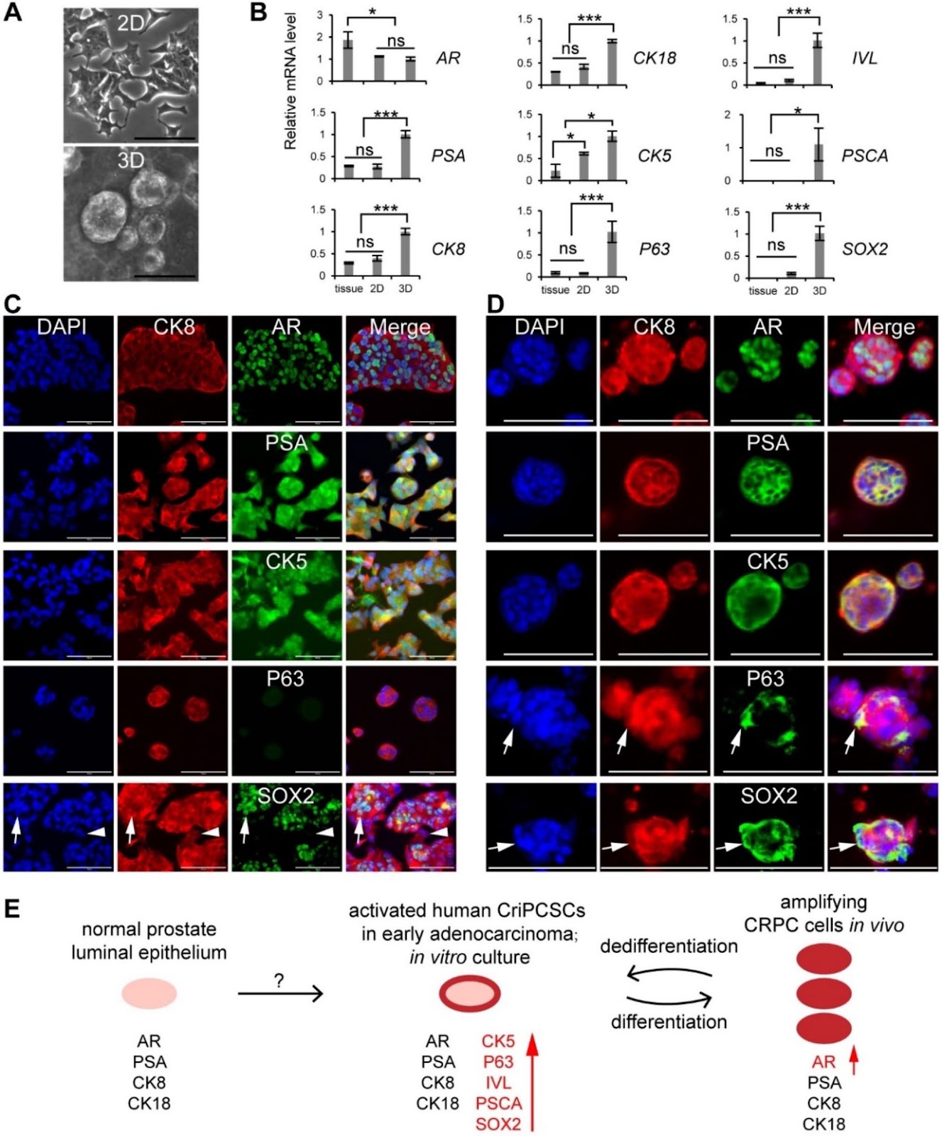 Human intermediate prostate cancer stem cells contribute to the initiation and development of prostate adenocarcinoma