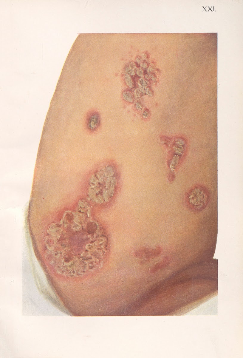 Venereal diseases  Syphilis Pl21 1908