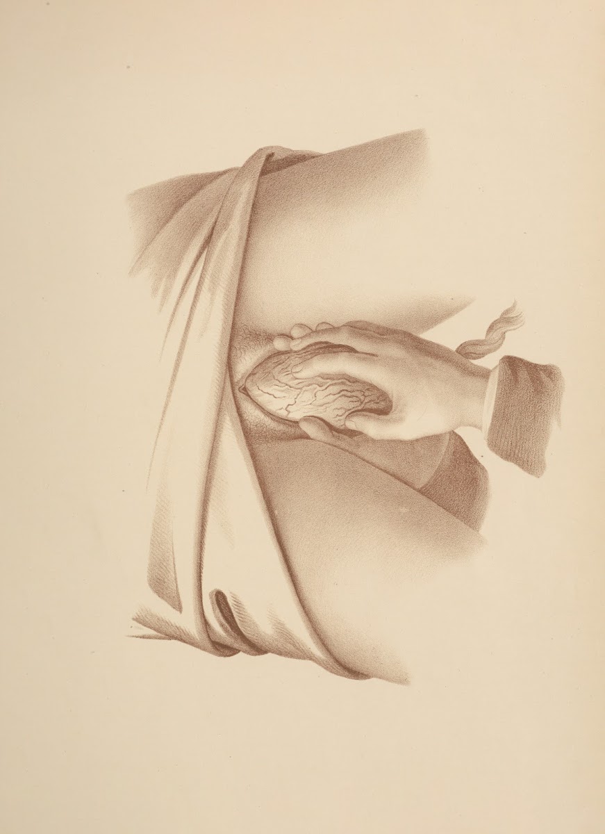 Removal of the Placenta Twisting the Membranes into a cord so that no portion ma