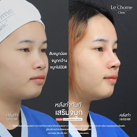 เสริมจมูกใหม่