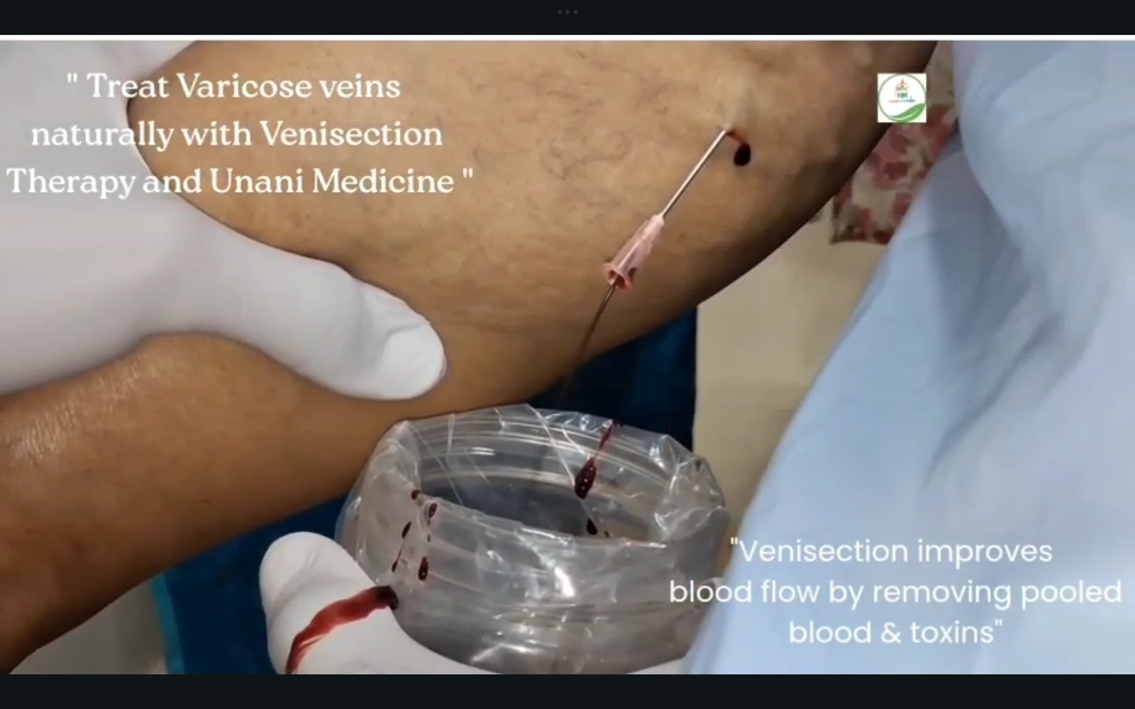 Venesection Result