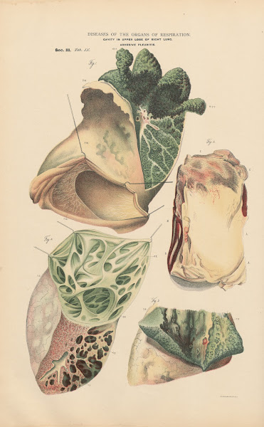 Cavity In Upper Lobe Of Right Lung 1888