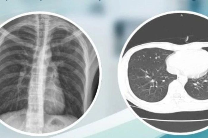 Trẻ khỏe mạnh tràn khí màng phổi mức độ nặng do vỡ kén khí - Báo Tri thức &amp; Cuộc sống