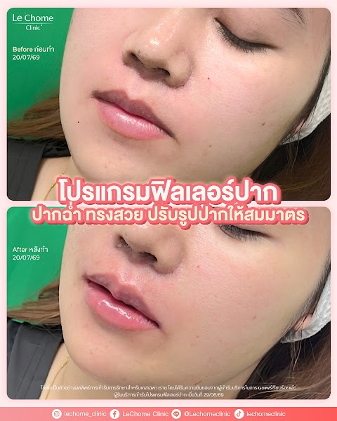 ฟิลเลอร์