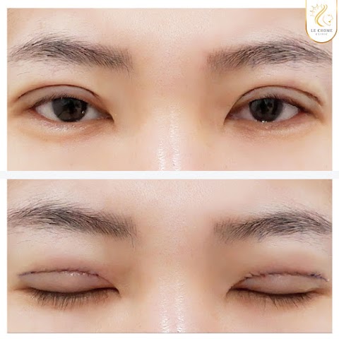 ตา 2 ชั้น