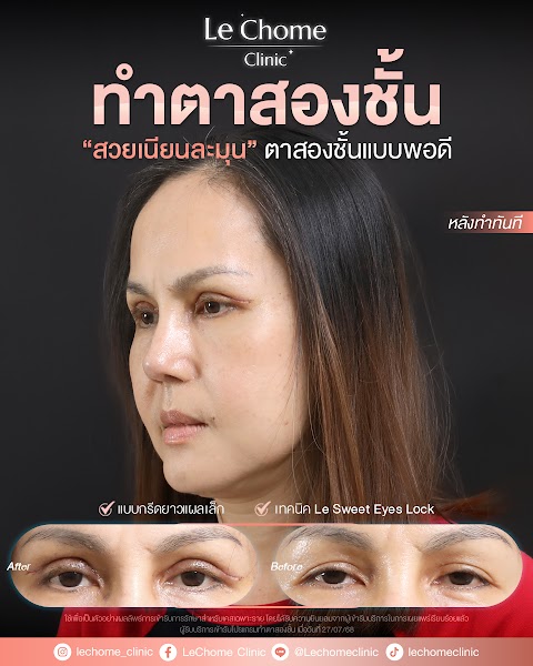 ตา 2 ชั้น