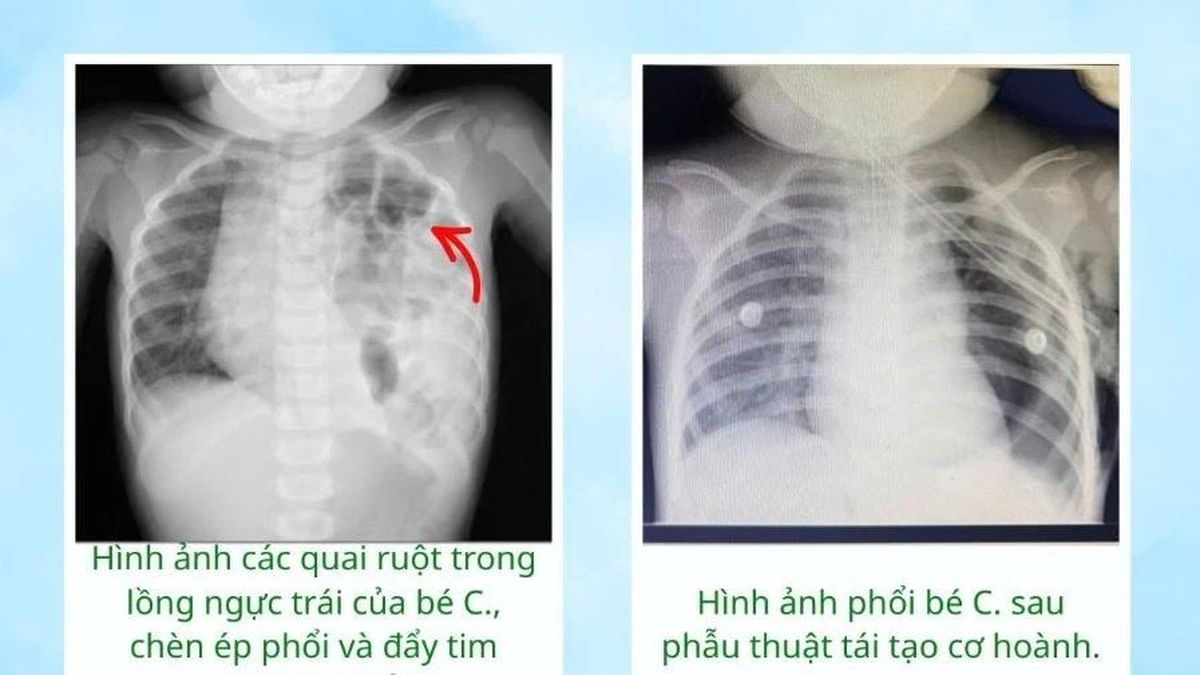 Ho kéo dài, bé gái 17 tháng tuổi phát hiện thoát vị hoành hiếm gặp - Báo Tri thức &amp; Cuộc sống