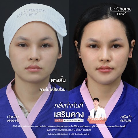เสริมคาง (ใหม่)