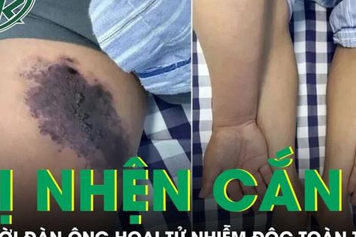 Người đàn ông bị nhện cắn hoại tử nhiễm độc toàn thân - Báo Sức Khỏe &amp; Đời Sống