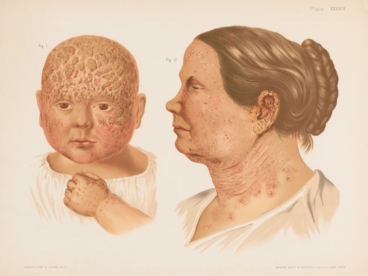 I Eczema Capitis II Eczema Faciei 1888 1889