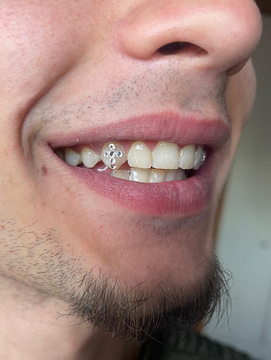 Gema dental con carácter