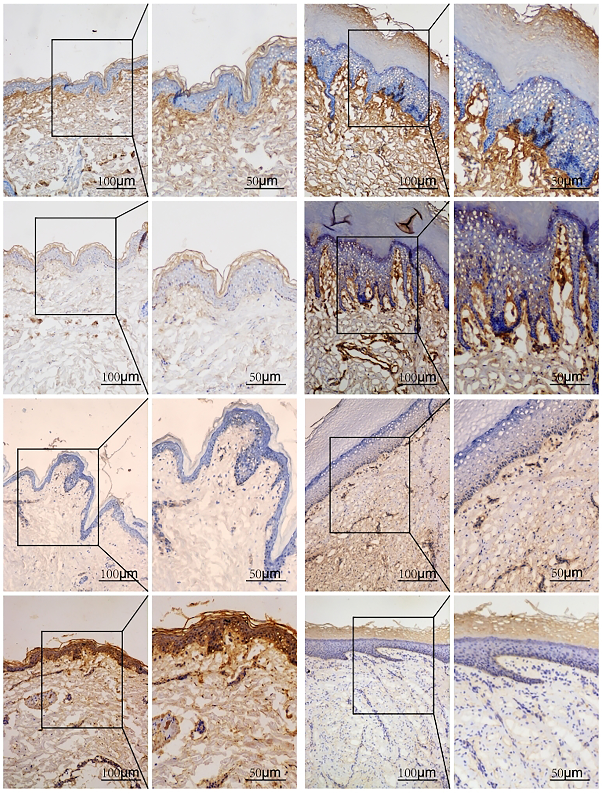 Regulatory role of ADAMTS8 in proliferation and apoptosis of hypertrophic scar fibroblasts