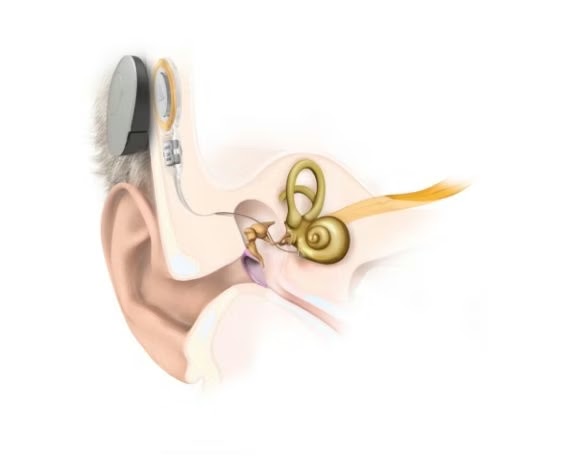 Schéma anatomique implant oreille moyenne