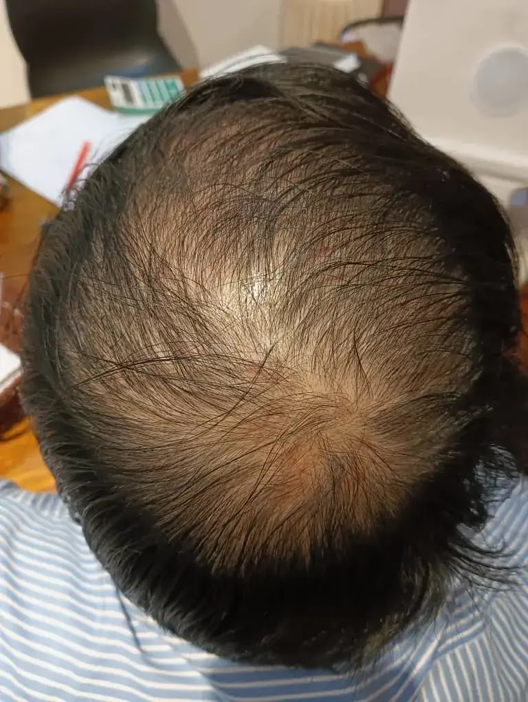 Male Pattern Baldness