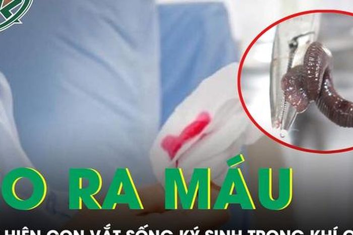 Ho ra máu suốt một tháng, bàng hoàng phát hiện con vắt sống ký sinh trong khí quản - Báo Sức Khỏe &amp; Đời Sống