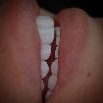 Ferrari Dental Clinic Beirut before after veneers Hollywood smile 2026