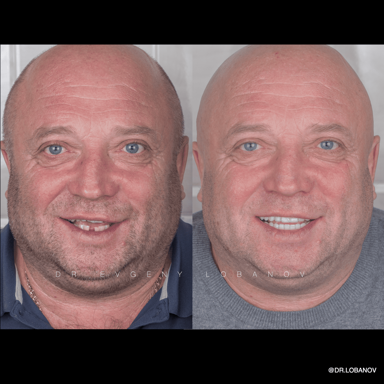 До и после установки керамических виниров