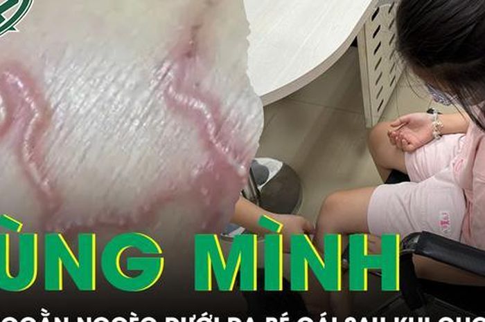Tá hỏa phát hiện bắp chân bé gái 9 tuổi đầy vết ngoằn ngoèo bất thường - Báo Sức Khỏe &amp; Đời Sống