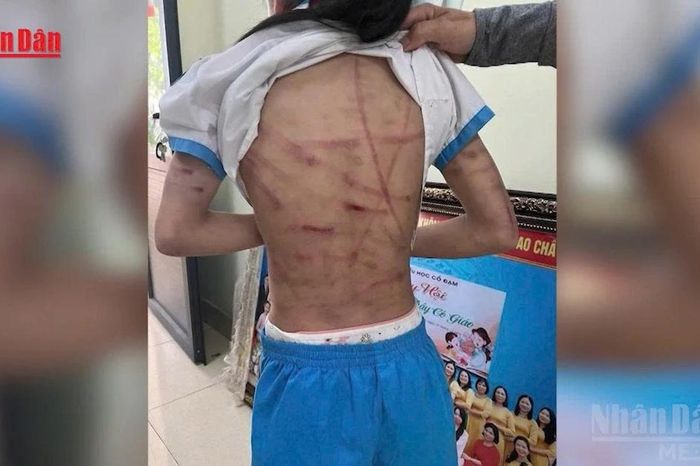 [Video] Bộ Y tế đề nghị lập đường dây nóng 24/7, xử nghiêm mọi hành vi che giấu bạo hành trẻ em - Báo Nhân Dân