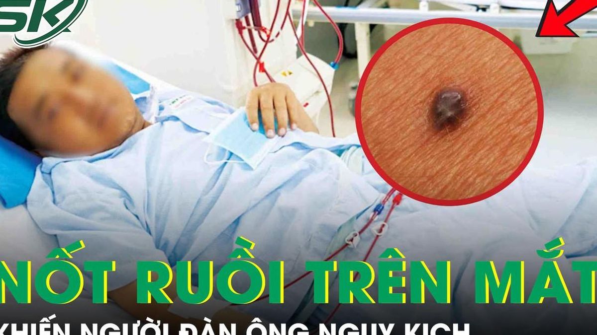 Người đàn ông nguy kịch từ nốt ruồi nhỏ, bác sĩ chỉ mặt dấu hiệu 'chí mạng' nhiều người bỏ qua - Báo Sức Khỏe &amp; Đời Sống
