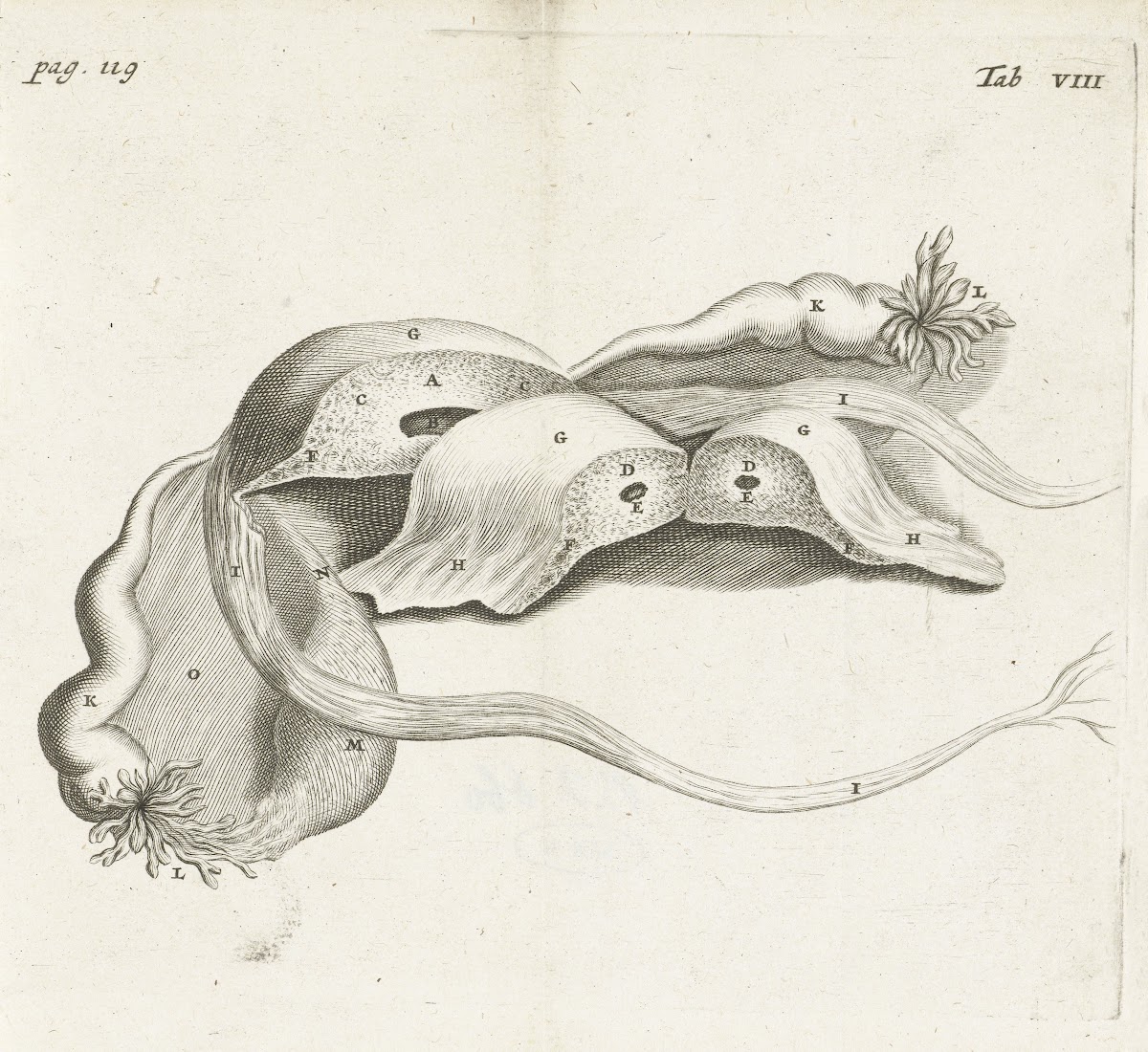 Anatomical image of an ectopic pregnancy 1672