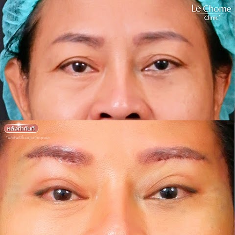 ตา 2 ชั้น
