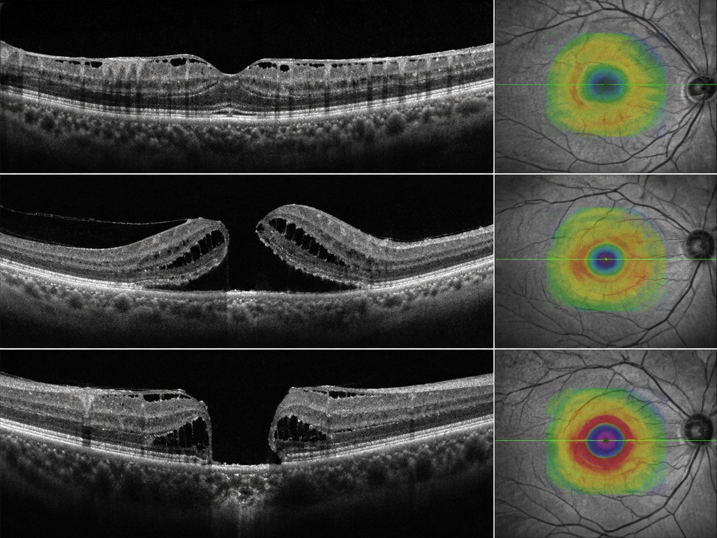 Sample OCT scan of the macula (ERM, VMT, macular hole)