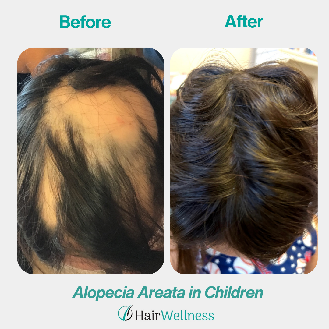 Alopecia areata treatment result