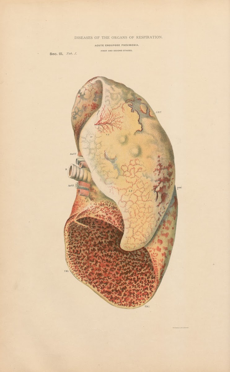 Acute Fibrinous Pneumonia 1888