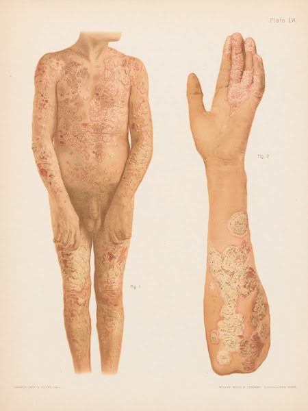 I Psoriasis Of Body II Psoriasis Of Hand And Arm 1888 1889