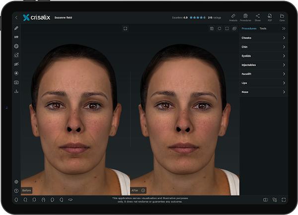 Tablette affichant l’interface de l’application Crisalix avec une simulation de visage 3D.