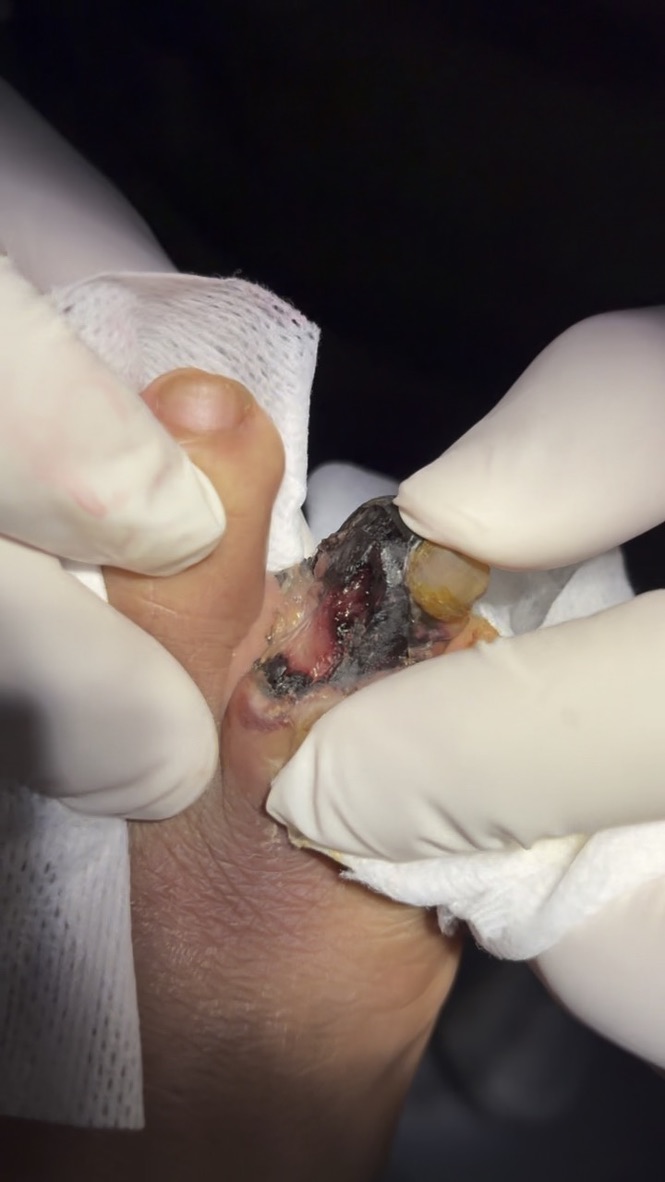 Atención de urgencias en Podiabetic
