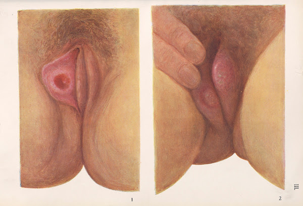 Venereal diseases  Syphilis Pl03 1908