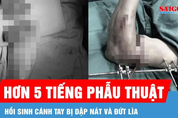 Hồi sinh cánh tay đứt lìa, dập nát do tai nạn lao động - Báo Sài Gòn Giải Phóng