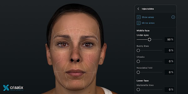 Simulation faciale 3D dans l’application Crisalix avec l’outil de procédure « Injectables » ouvert. 2400px x 1200px.
