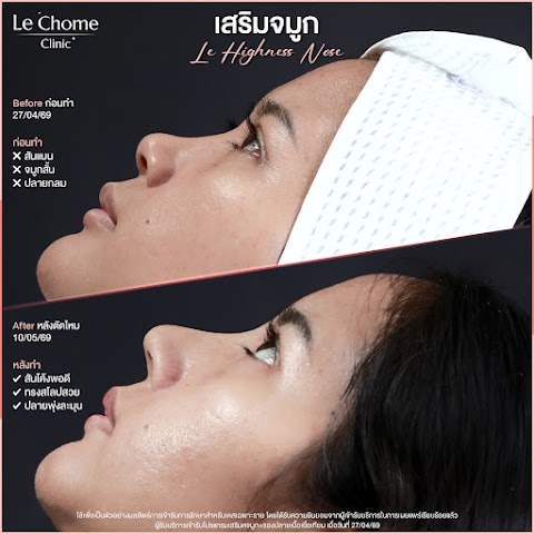 เสริมจมูก