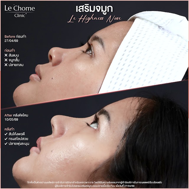 รีวิวเสริมจมูก — เสริมจมูก