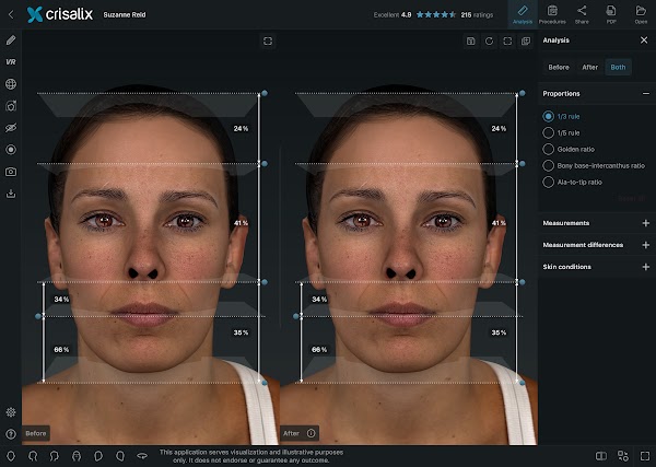 Simulation de visages 3D dans l’application Crisalix avec l’outil « Analyse » ouvert.