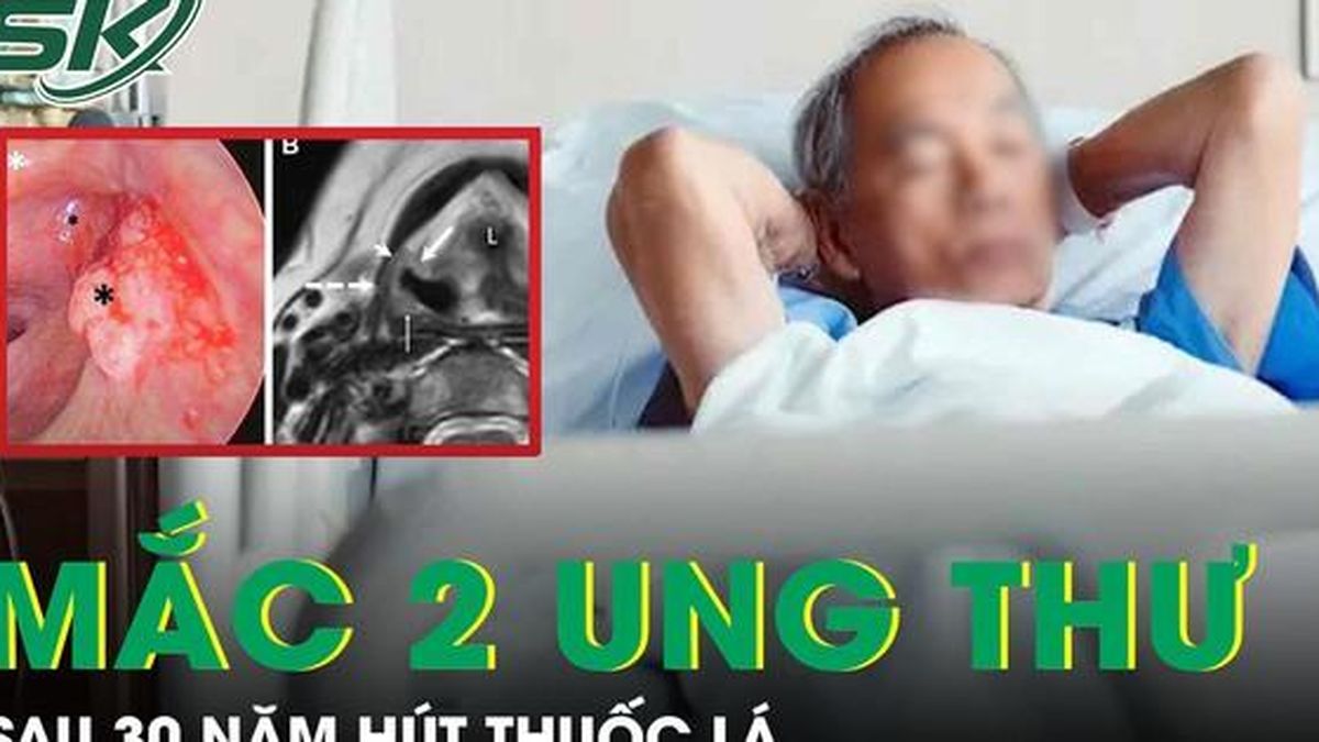 Người đàn ông 56 tuổi mắc cùng lúc hai ung thư sau 30 năm hút thuốc lá - Báo Sức Khỏe &amp; Đời Sống