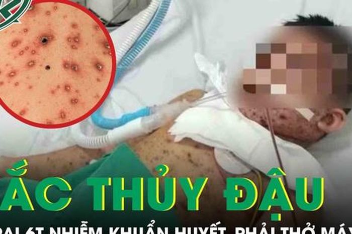 Biến chứng thủy đậu, bé trai 6 tuổi nhiễm khuẩn huyết, phải thở máy nguy kịch - Báo Sức Khỏe &amp; Đời Sống