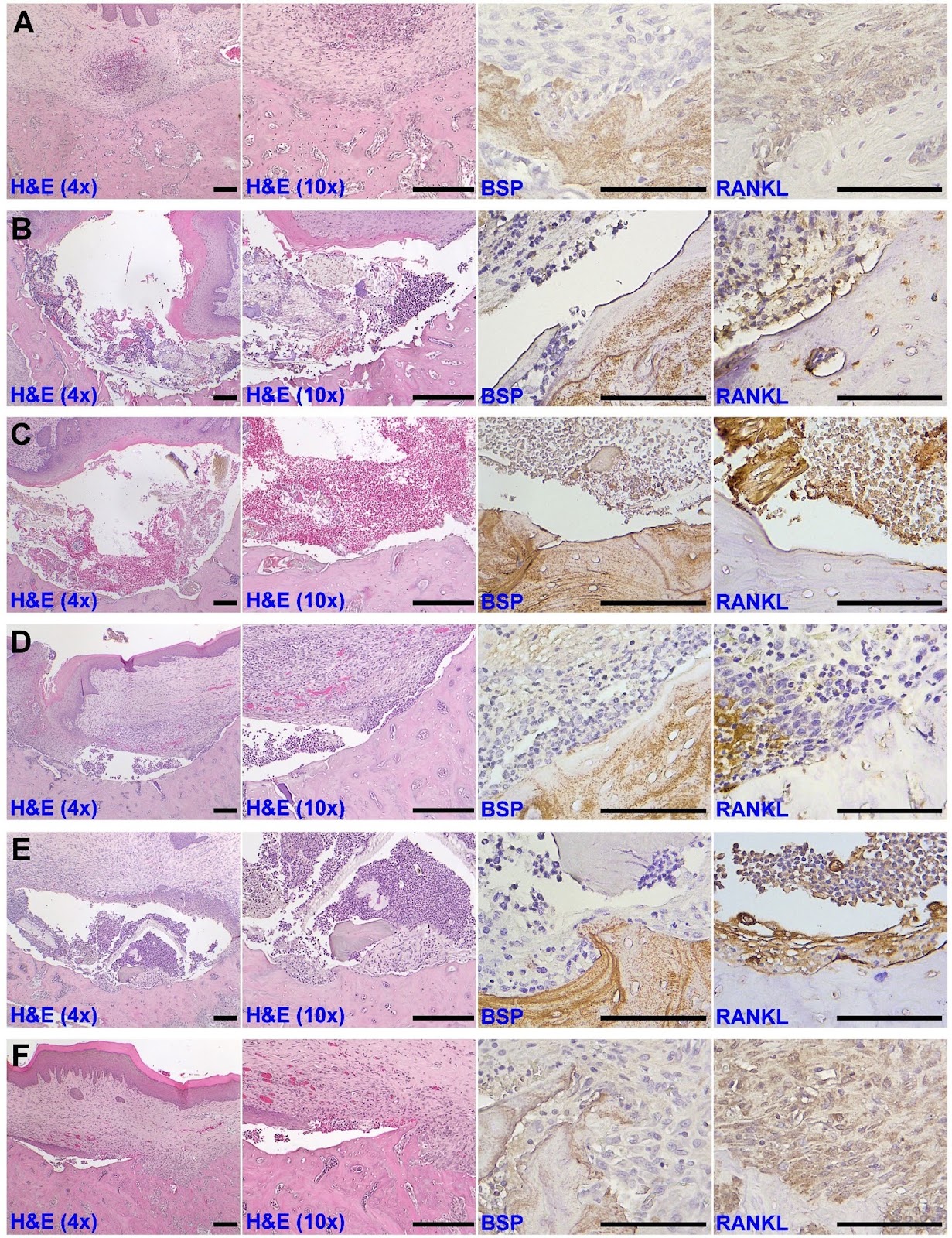 A GelMA/polydopamine hydrogel with PTH and osteogenically stimulated alveolar mucosa-derived stem cells promotes bone regeneration in MRONJ-affected wounds
