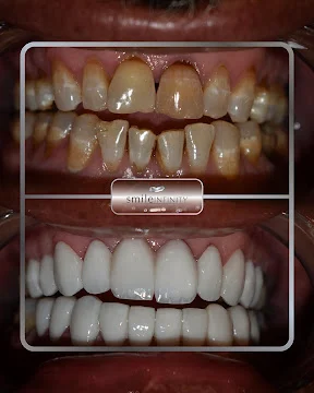 veneers before after Lebanon Jounieh ZEvolution no-prep Hollywood smile 2026