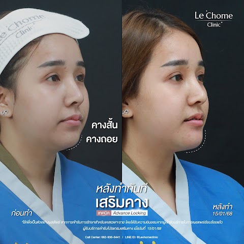 เสริมคาง (ใหม่)