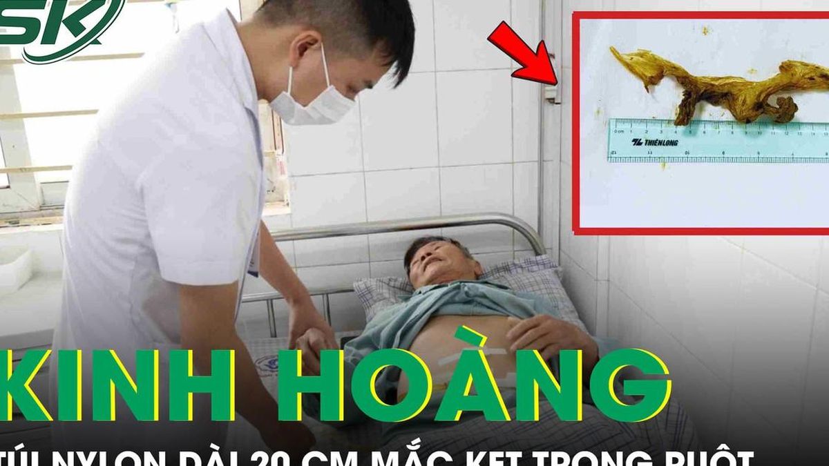 Kinh hoàng: Túi nilon dài 20 cm mắc kẹt trong ruột bệnh nhân - Báo Sức Khỏe &amp; Đời Sống
