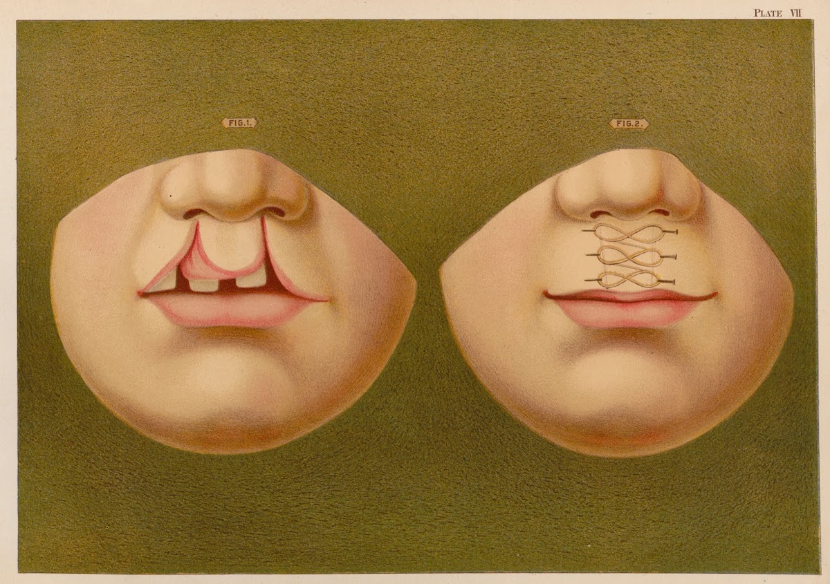 Double hare lip 1889