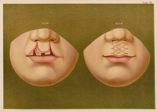 Double hare lip 1889